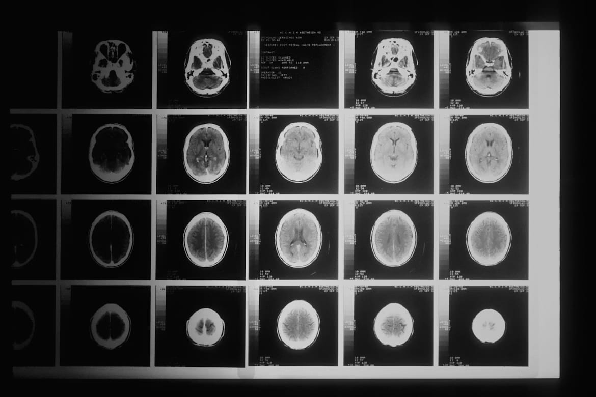 Black and white brain scan film showing multiple scan slices